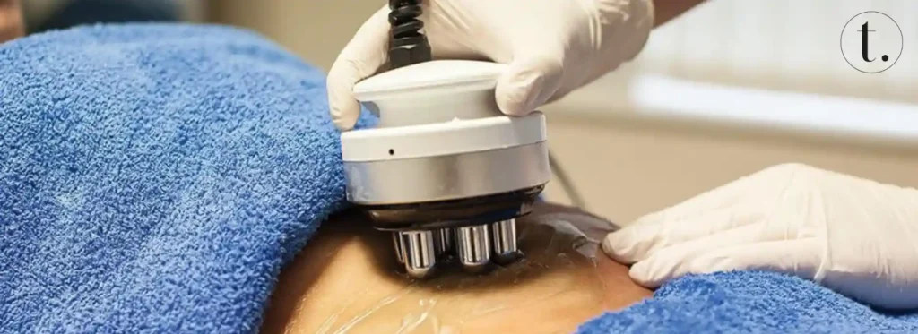 Radiofrequency (RF) Lipolysis non-surgical fat loss treatments in action